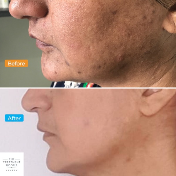 Vampire Facial 1